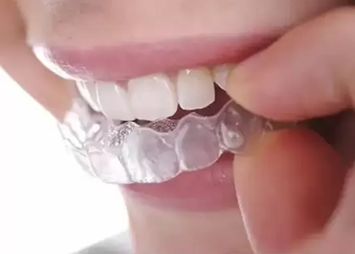 》Comfortable Orthodontic Braces