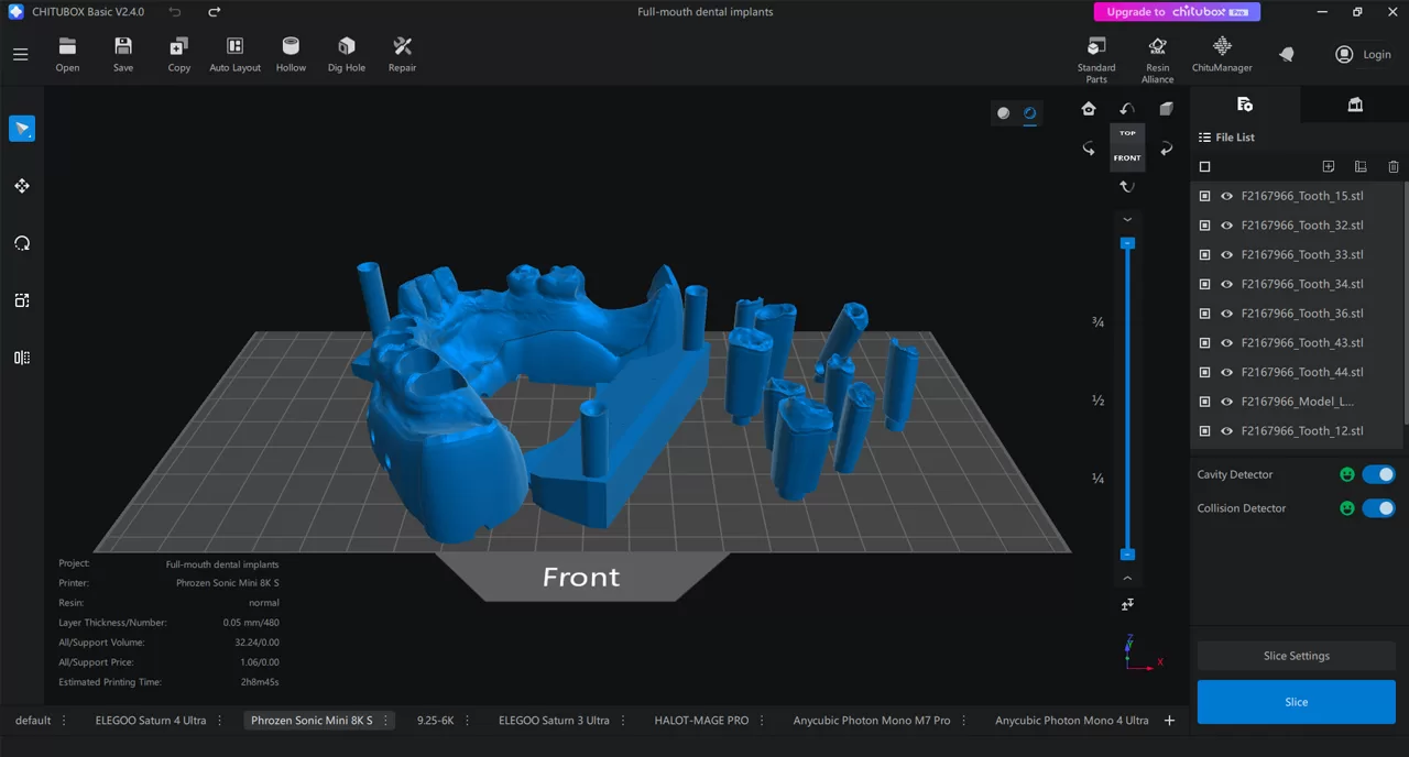 Full Mouth Implant Model design 1