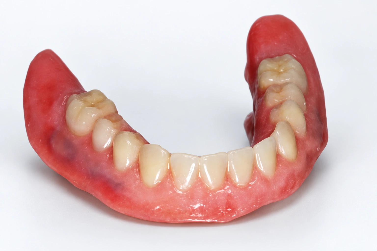 AI-adapted view of gingival surface characterization based on Figure 6 of a published denture case report